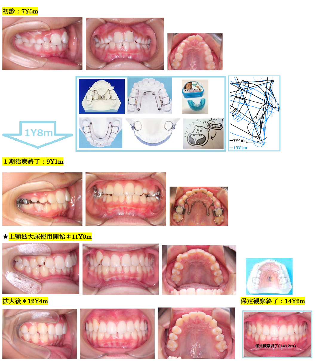 前歯矯正の経過
